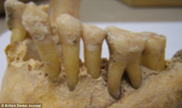 Professor Francis Hughes, of King’s College London, said: ‘We were very struck by the finding severe gum disease appeared to be much less common in the Roman-British population than in modern humans - despite the fact that they did not use toothbrushes or visit dentists as we do today Ancient diseased teeth are pictured